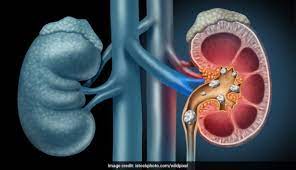 Cara mengeluarkan batu ginjal tanpa operasi
