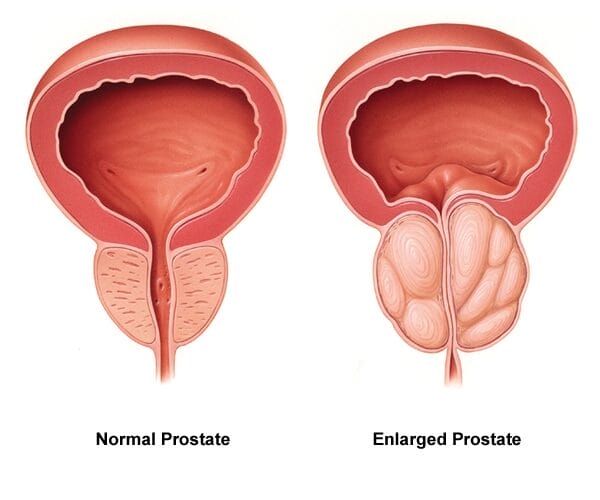 Pengobatan Fisioterapi yang Efektif untuk Mengobati Pembesaran Prostat Pada Pria