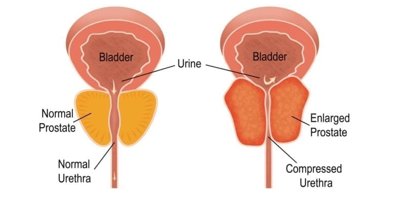 Hal yang Menyebabkan Seorang Terkena Pembesaran Prostat 