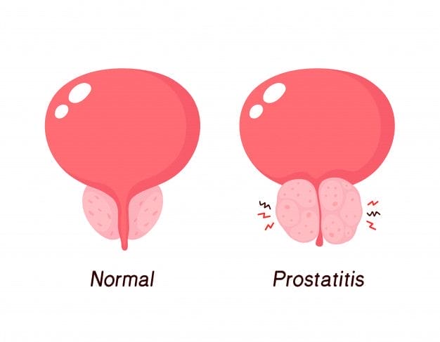 Premium Vector Normal Prostate And Benign Prostatic Hyperplasia