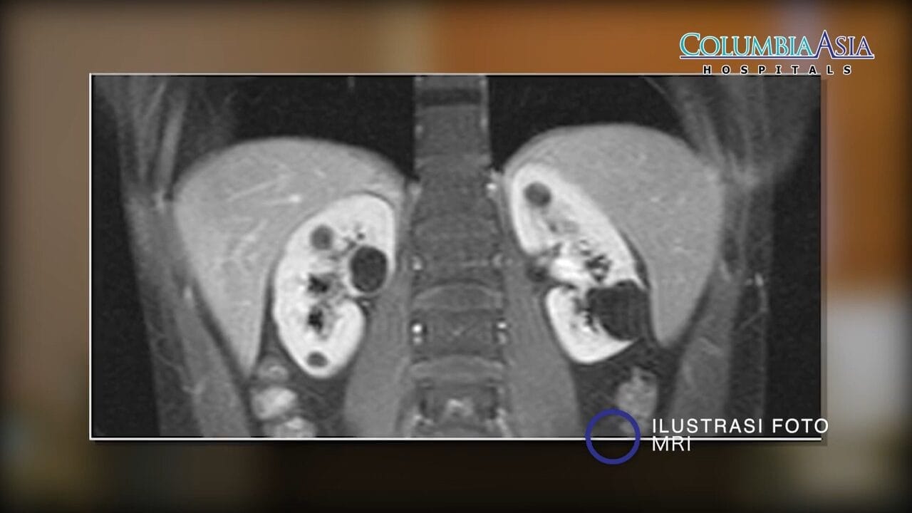 lokasi nyeri batu ginjal