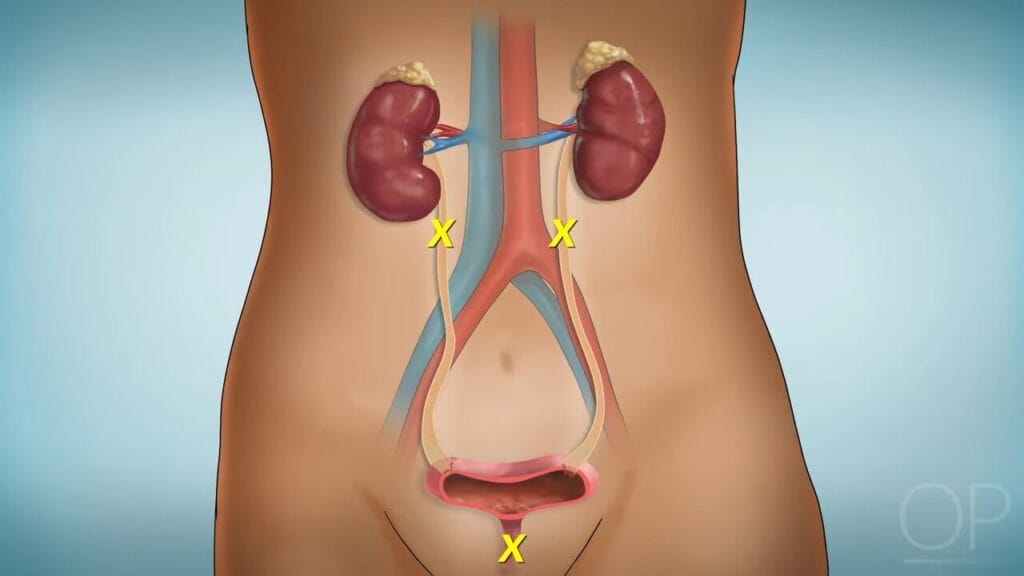 Kapan Operasi Batu Ginjal Diperlukan