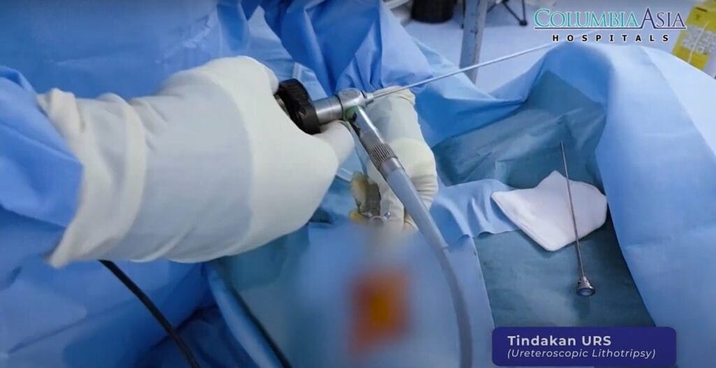 Seorang dokter sedang melakukan prosedur ureteroskopi menggunakan endoskop untuk menghilangkan batu ginjal pada pasien di ruang operasi.