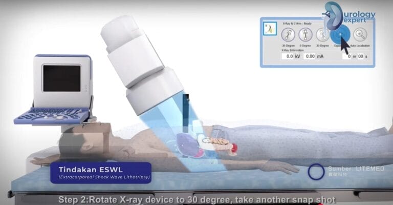 Seorang pasien menjalani prosedur ESWL untuk penghancuran batu ginjal.