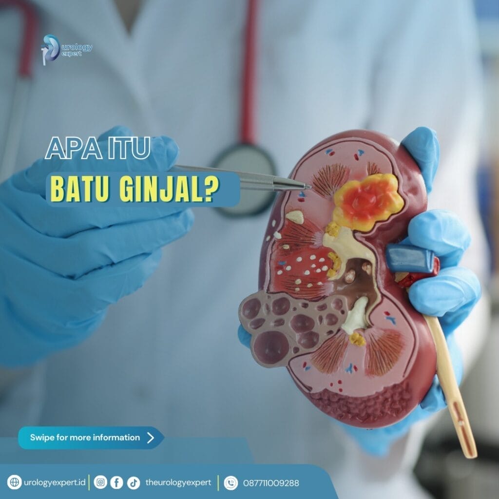 Waspada Penyebab, Gejala Batu Ginjal Dan Pengobatannya