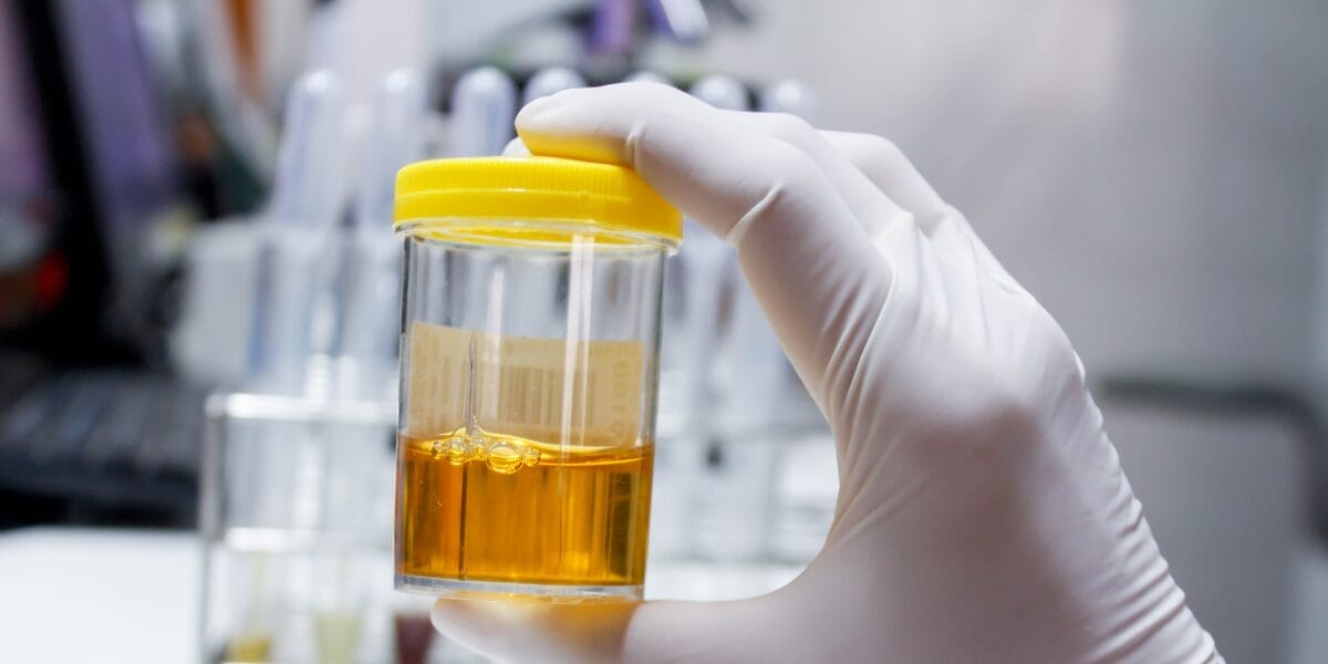 hematuria mikroskopis