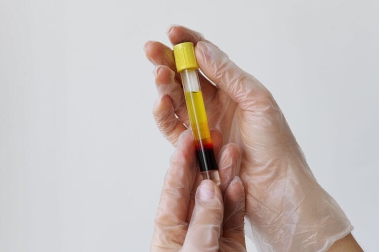 hematuria