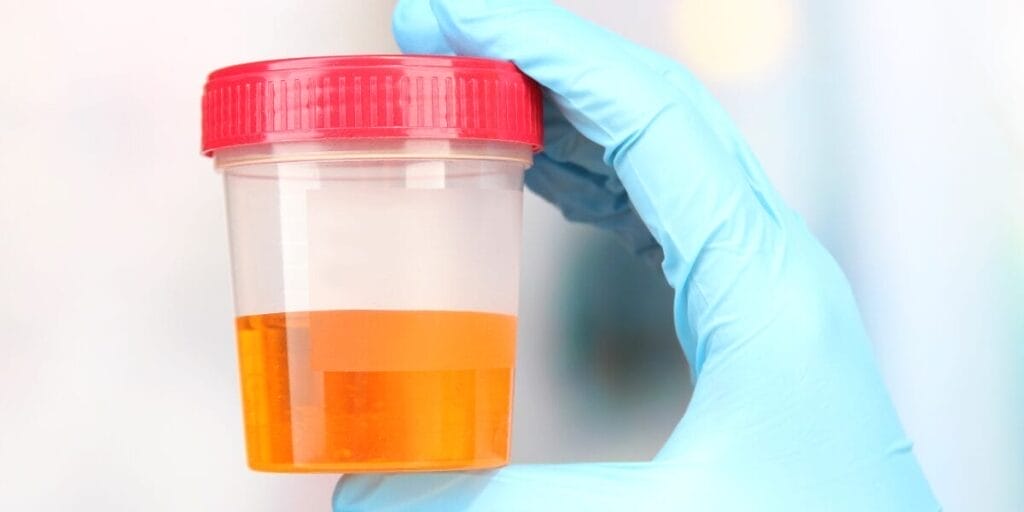hematuria