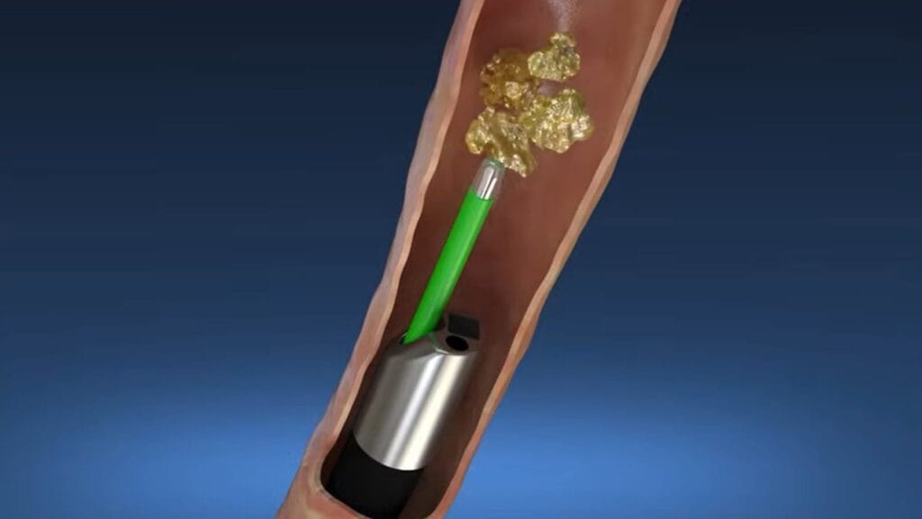 ureteroscopy