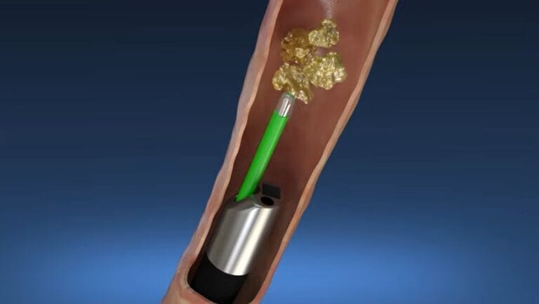 ureteroscopy