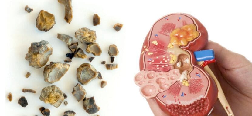 Diagram ginjal di samping beberapa batu ginjal dengan berbagai ukuran ditampilkan dengan latar belakang putih, yang mengilustrasikan pendekatan Konsep Otomatis untuk mengidentifikasi dan menganalisis pembentukan batu ginjal.